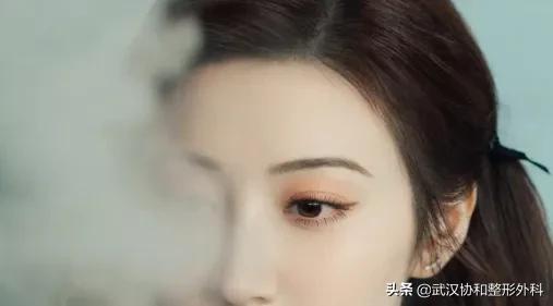 提眉术加开眼角,泡泡眼提眉术