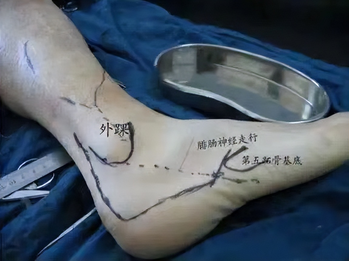 跗骨窦手术能治好吗,跗骨窦入路治疗跟骨骨折适应症