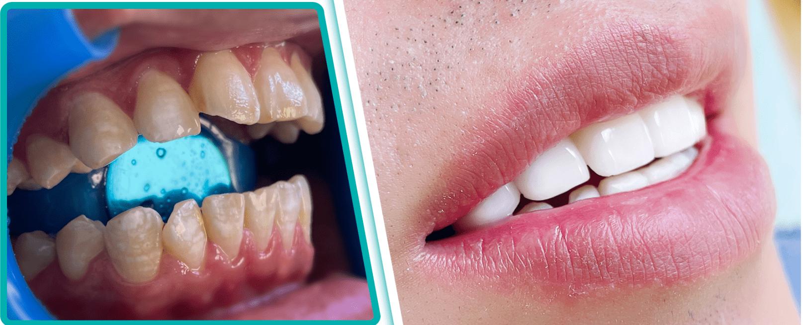 氟斑牙是刷牙引起来的吗,氟斑牙可以洗下去吗