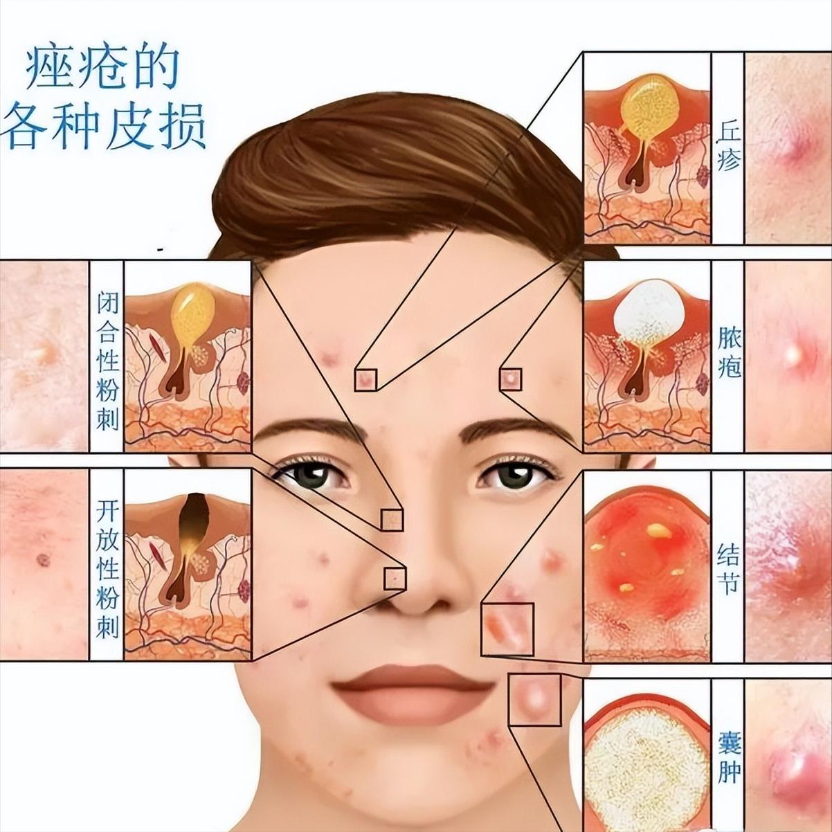 痘痘增生疤痕疙瘩怎么能彻底消除,如何分辨凸起的是痘痘还是疤痕