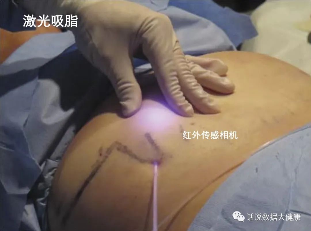 激光减脂，又一个明星医美产品，效果如何？
