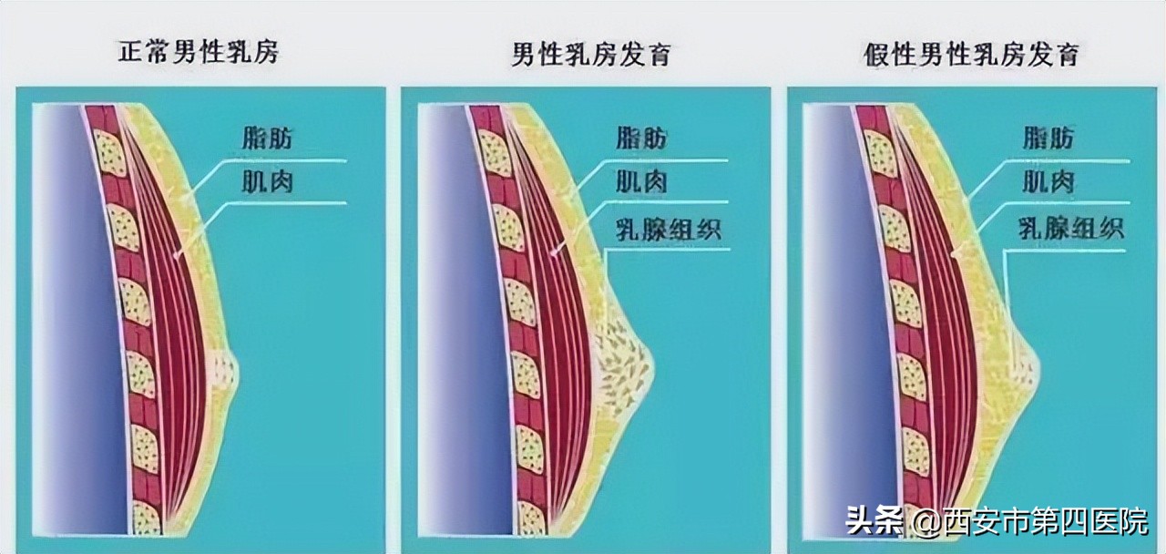 #健康中国行动2030#胸大真尴尬，18岁小伙胸部异常隆起……这个病也会找上“他们”