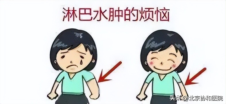 协和医院乳腺淋巴水肿,乳腺癌术后淋巴水肿专家共识