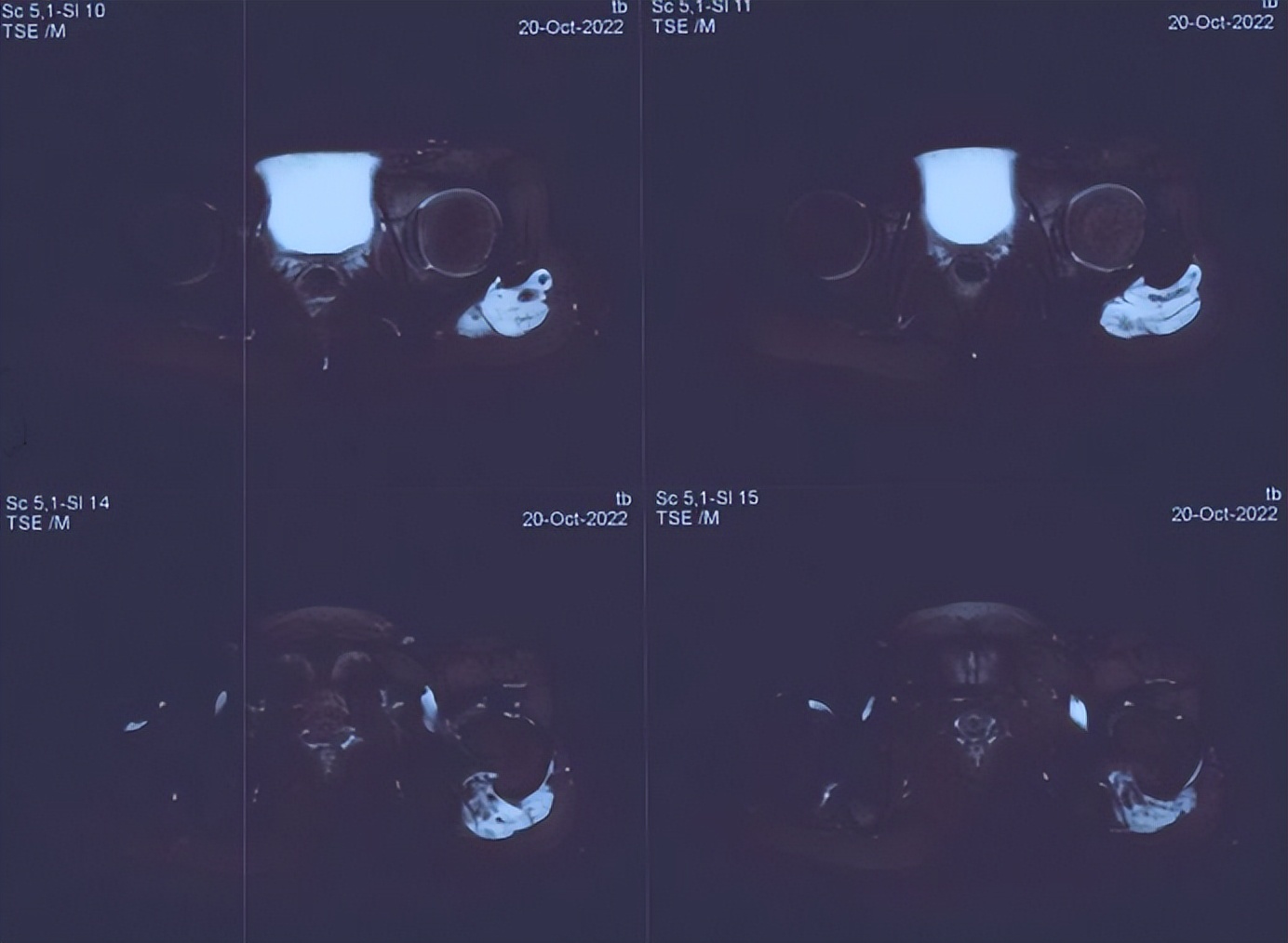 下肢肌间静脉畸形治疗案例,臀部静脉畸形怎么治疗比较好