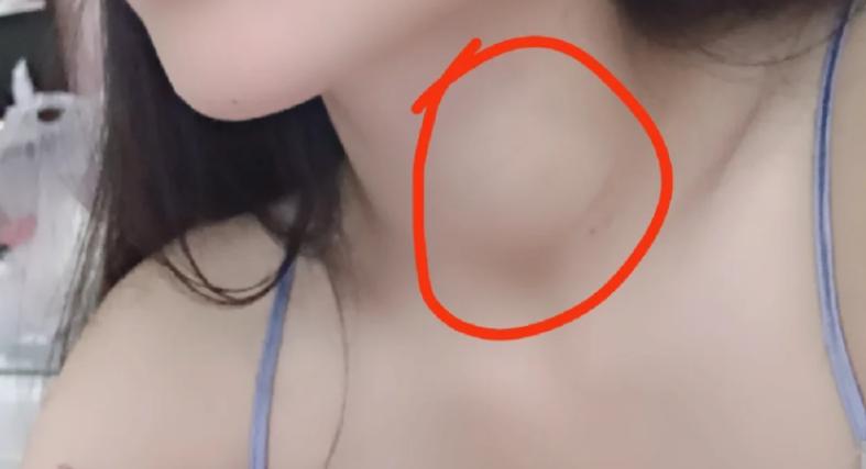 熬夜对甲状腺结节有影响吗,甲状腺结节的两大雷区有哪些