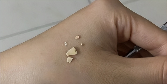 牙结石最简单的清除方法,牙结石最简单处理方法又有效