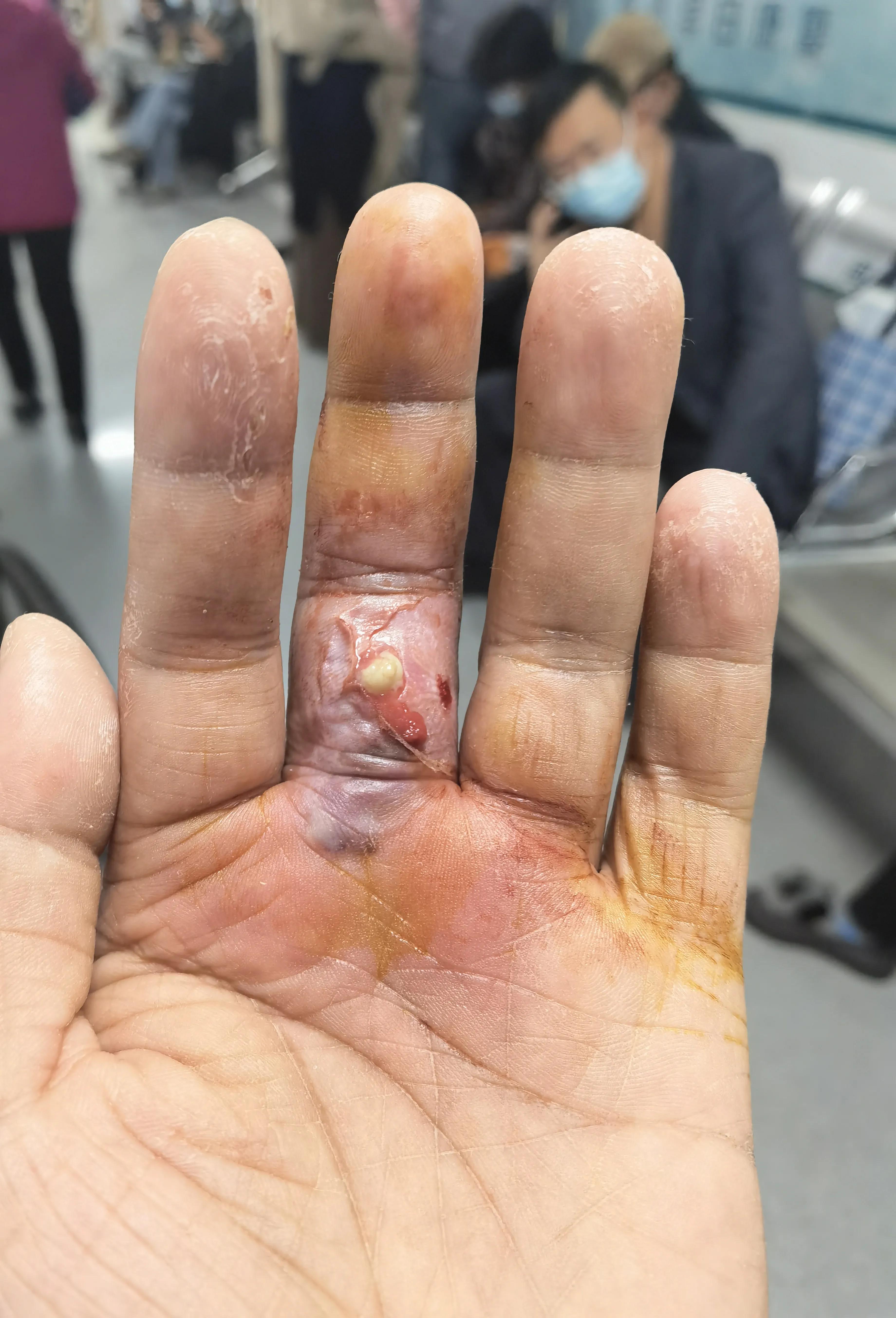 被野猫抓伤破皮要不要打针,被野猫抓伤后打疫苗多少钱