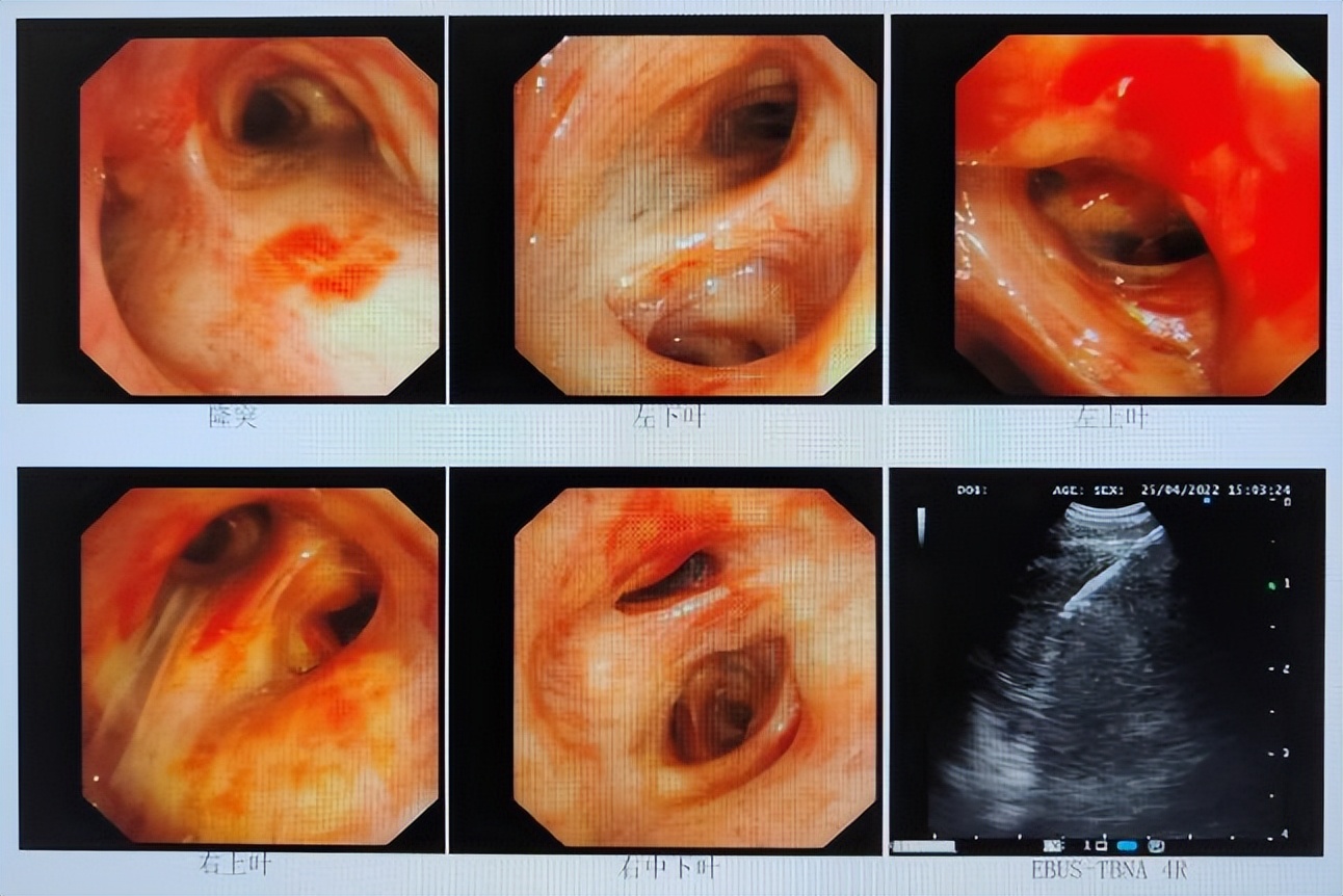斯鲁利单抗治疗小细胞肺癌生存期,小细胞肺癌3a期用斯鲁利单抗