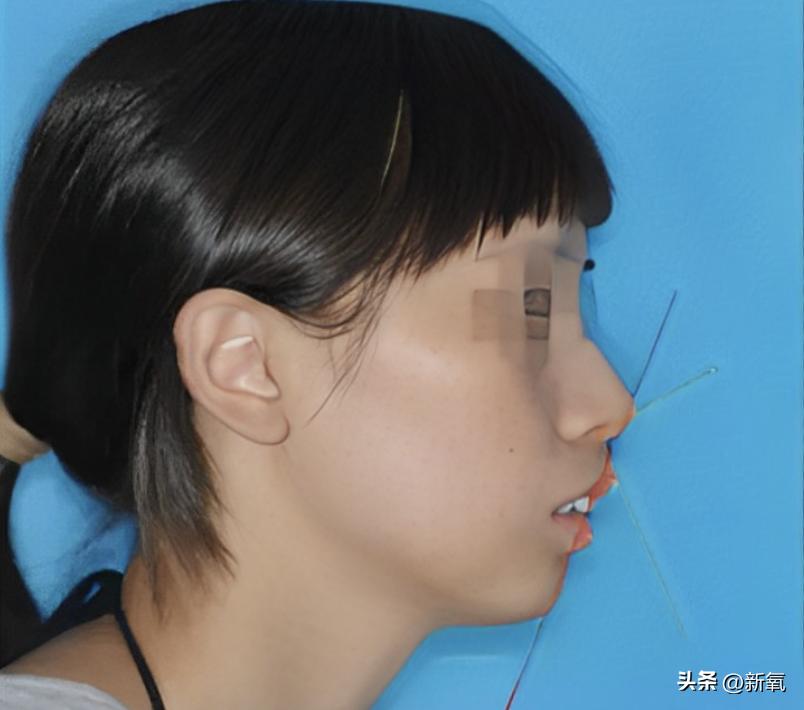 牙齿正畸和骨骼正畸的区别,牙齿正畸和眼轴增长有关系吗