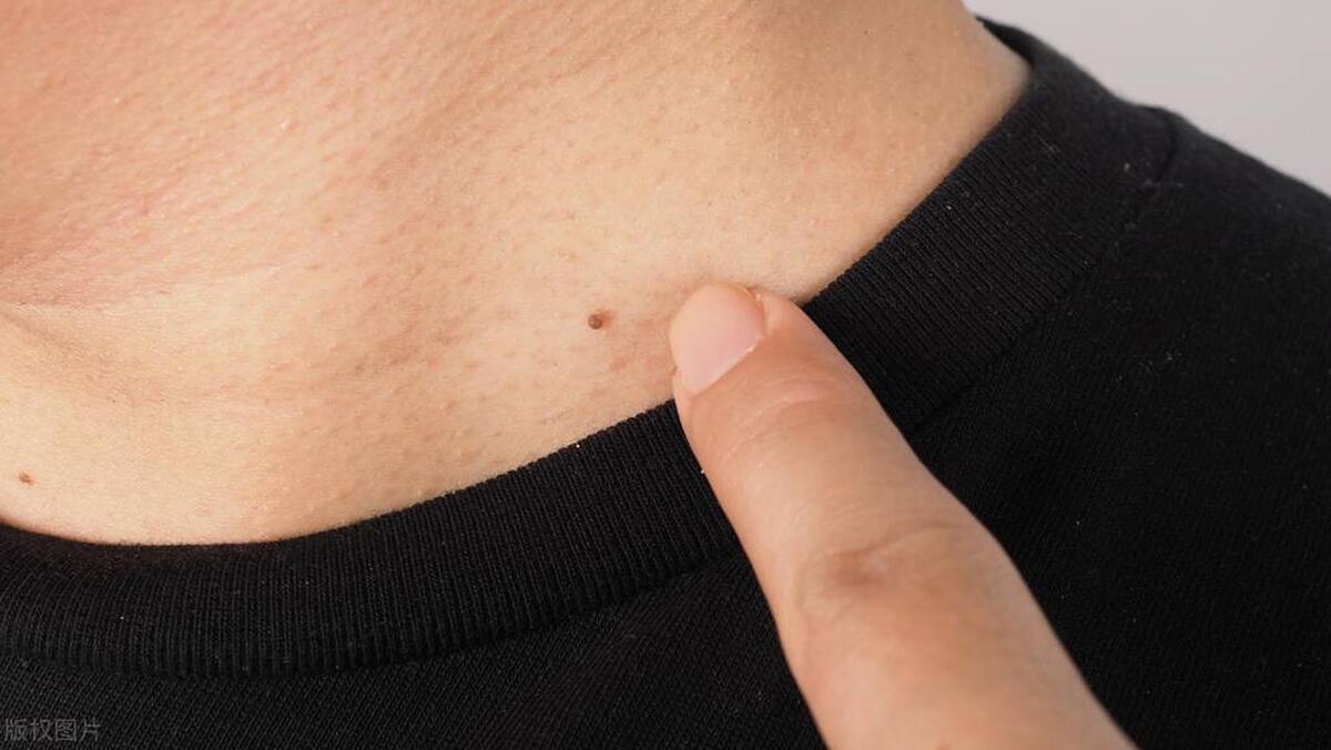 点丝状疣后注意什么,丝状疣饮食的注意事项