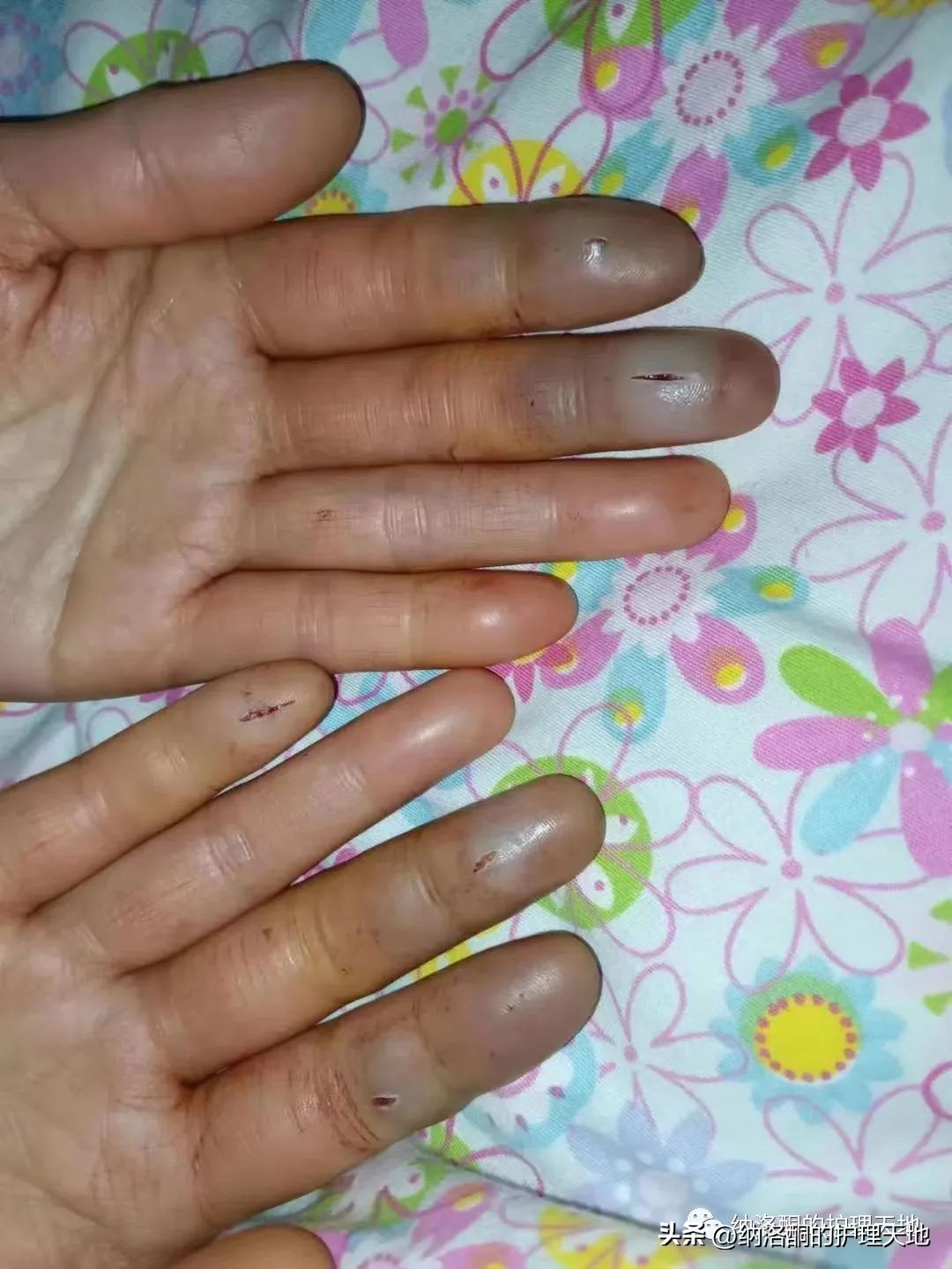 轻微冻伤时的有效救治方法,冻伤急救和治疗原则有哪些