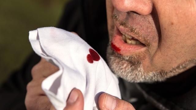 得了肺脓肿怎么办,肺脓肿怎么才能算彻底治愈