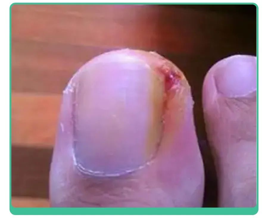 小孩指甲凹陷变黑有坑是什么原因,小孩指甲有白点和细纹是怎么回事