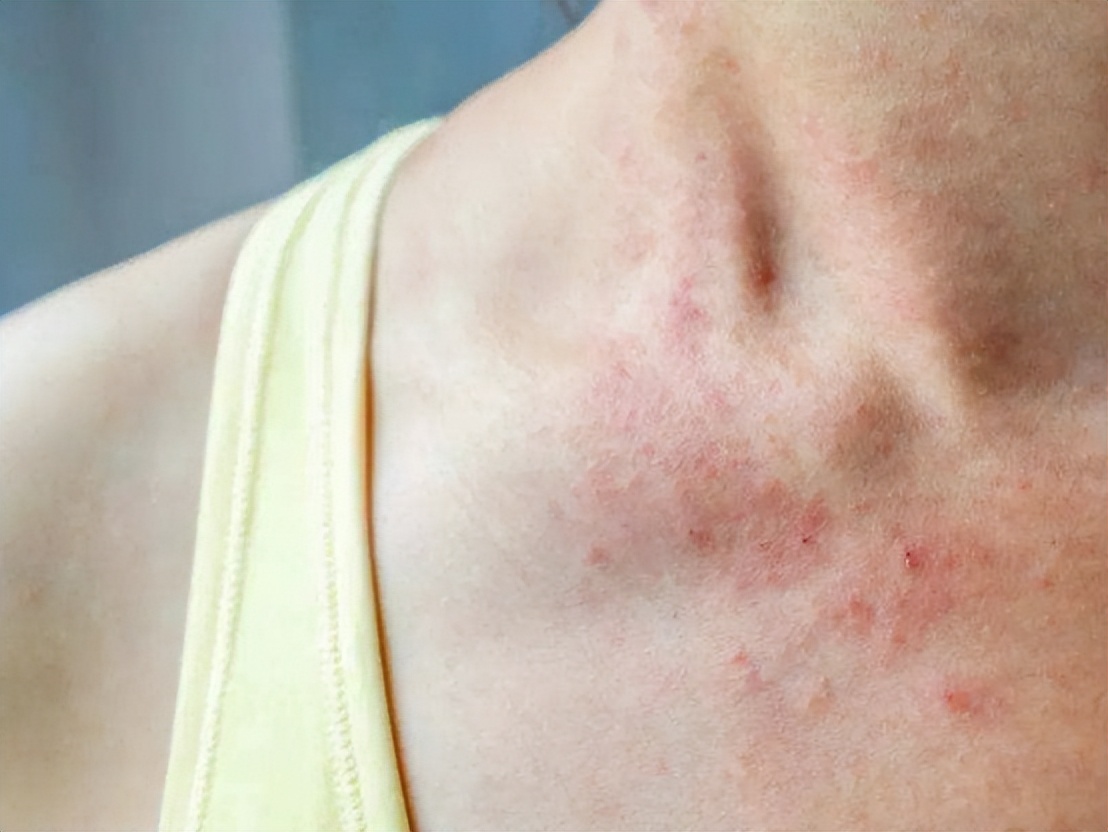 神经性皮炎喝过中药后为啥更痒,手越抓越痒是皮炎还是真菌感染