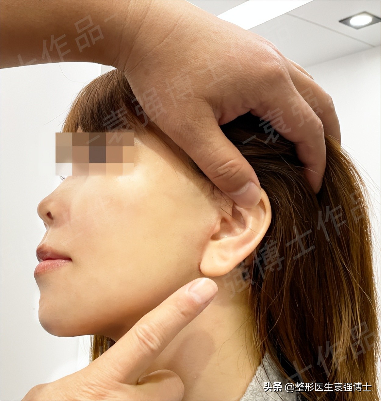 拉皮术后无美颜对比图,40岁拉皮术后恢复视频