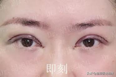 为什么很多人喜欢双眼皮,为什么男生喜欢双眼皮的女孩