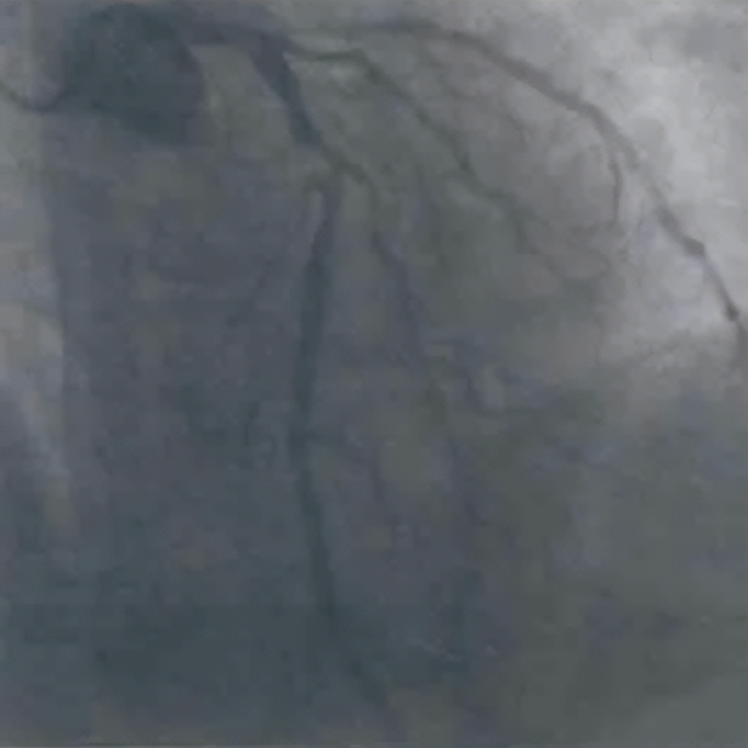 急诊PCI指南,急诊pci治疗费用