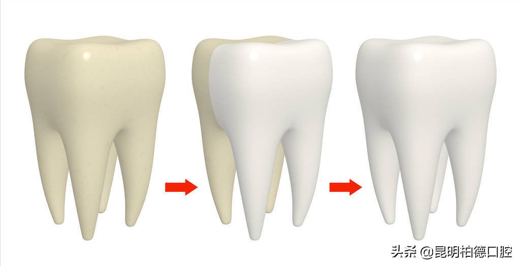 洗牙喷砂和龈下刮治的区别,洗牙套餐里喷砂是什么意思