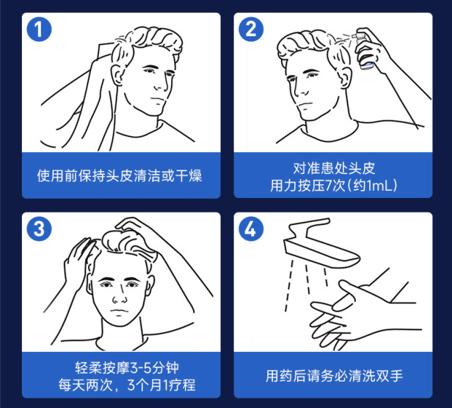 已经不脱发了用米诺地尔能生发吗,米诺地尔生发需要常年用吗
