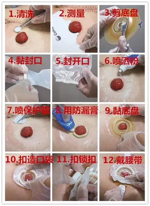 结肠癌患者术后吃什么最好,结肠癌术后的饮食注意事项