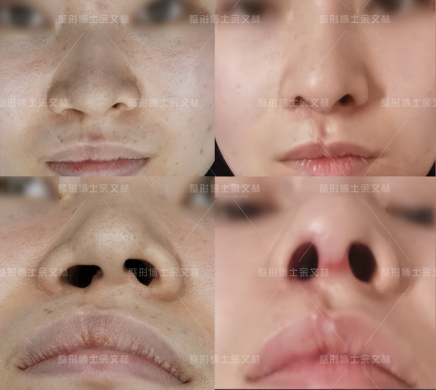 唇裂鼻畸形一期,隐形唇裂会越来越严重吗