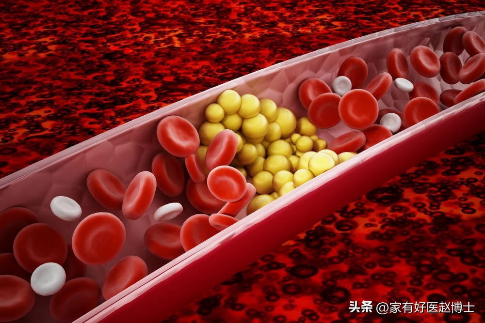 胆固醇正常以后他汀还要吃吗,胆固醇高吃他汀要一直吃吗