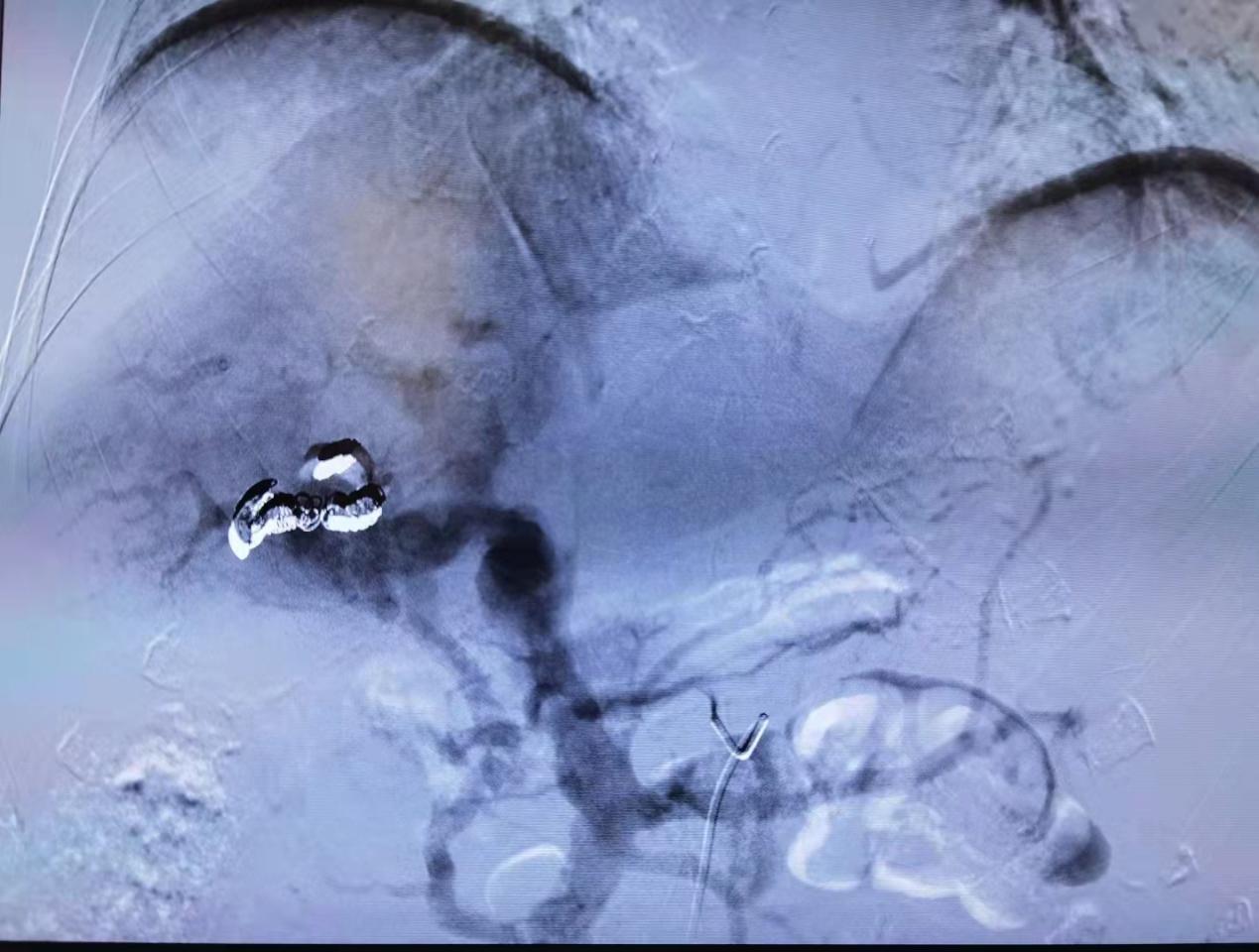 南昌大学二附院消化内科成功运用弹簧圈联合组织胶栓塞技术治疗一例高难度肝动脉-门静脉瘘患者