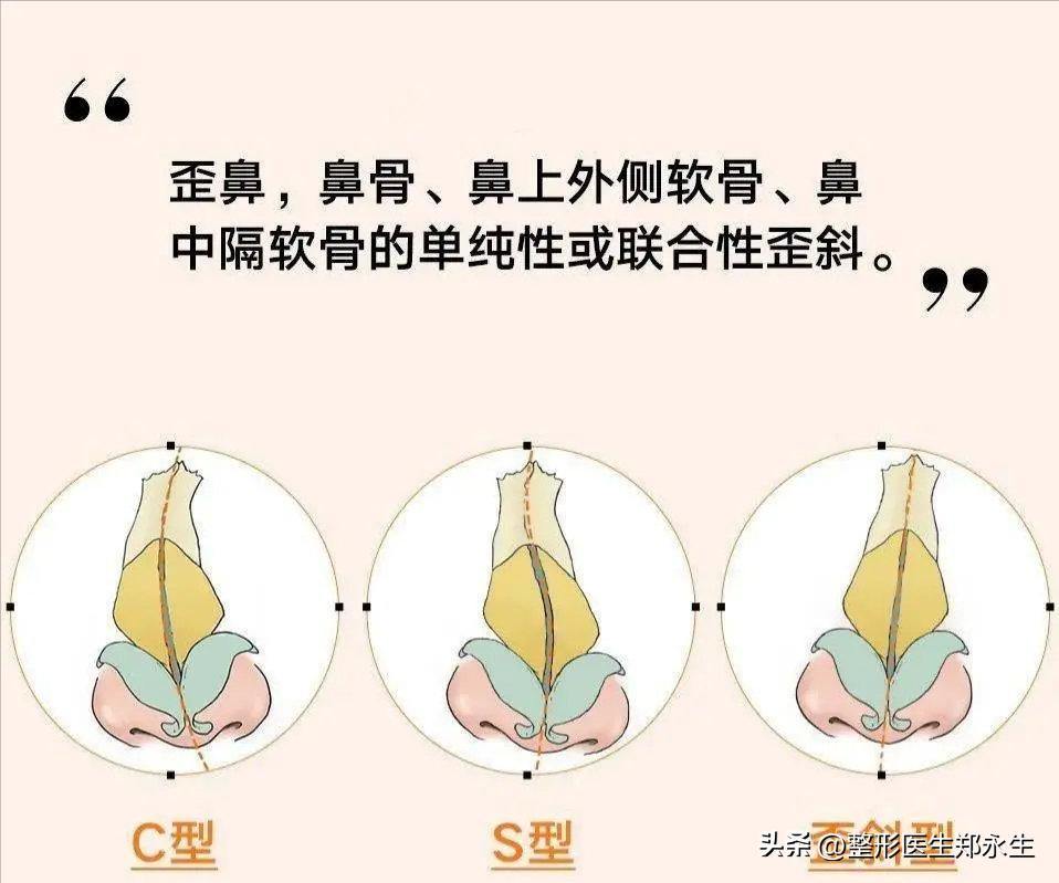 歪鼻是什么原因引起的,歪鼻歪鼻