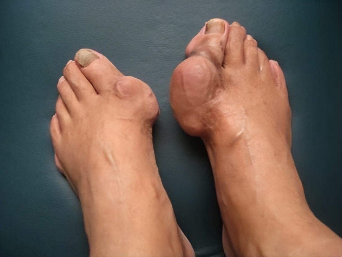 名中医治疗痛风处方,古方通治痛风效果怎么样