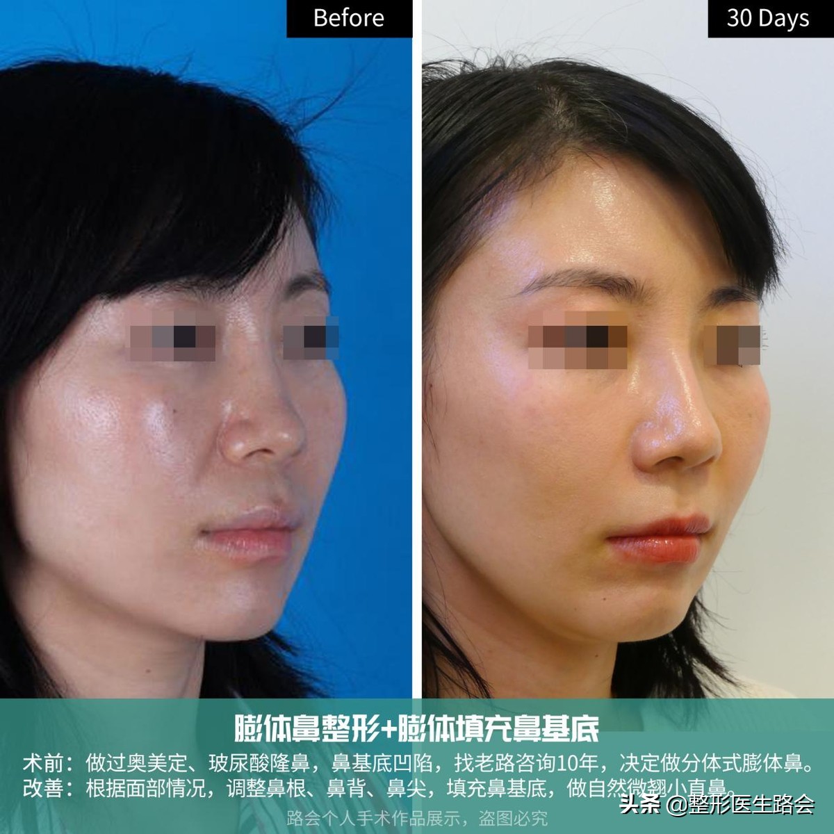 鼻基底填充法令纹瞬间消失,鼻基底填充后法令纹能改善多少