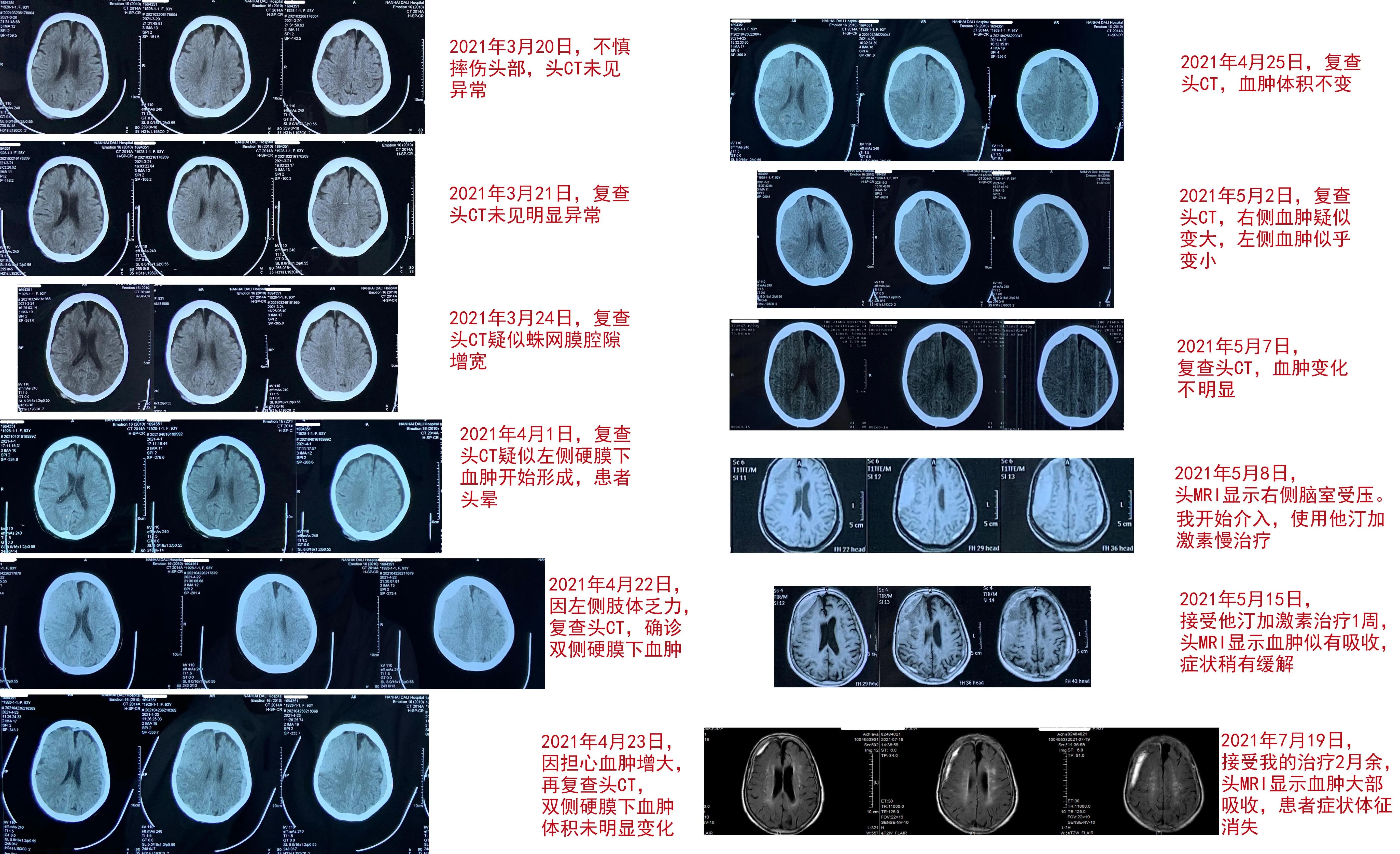 硬膜下血肿的护理诊断及措施,硬膜下血肿mr分期表现