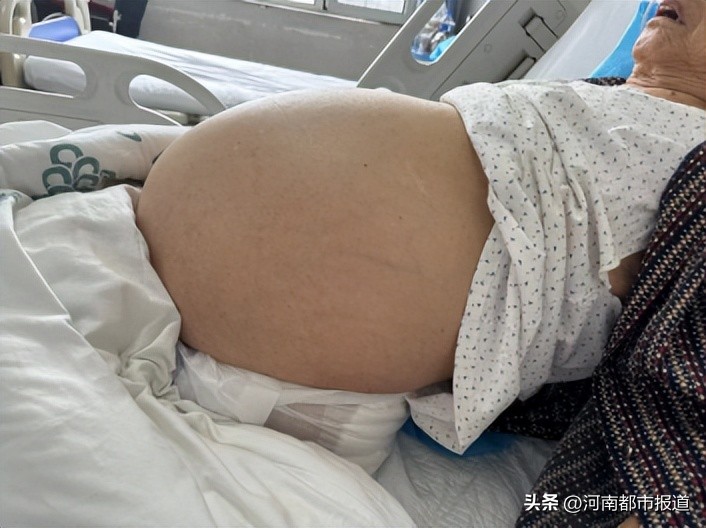 96岁老人腹腔取出近30斤重肿瘤，医院精心护理术后两天转回普通病房