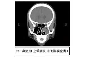 宝璋医院|感冒还是鼻窦炎？傻傻分不清楚？