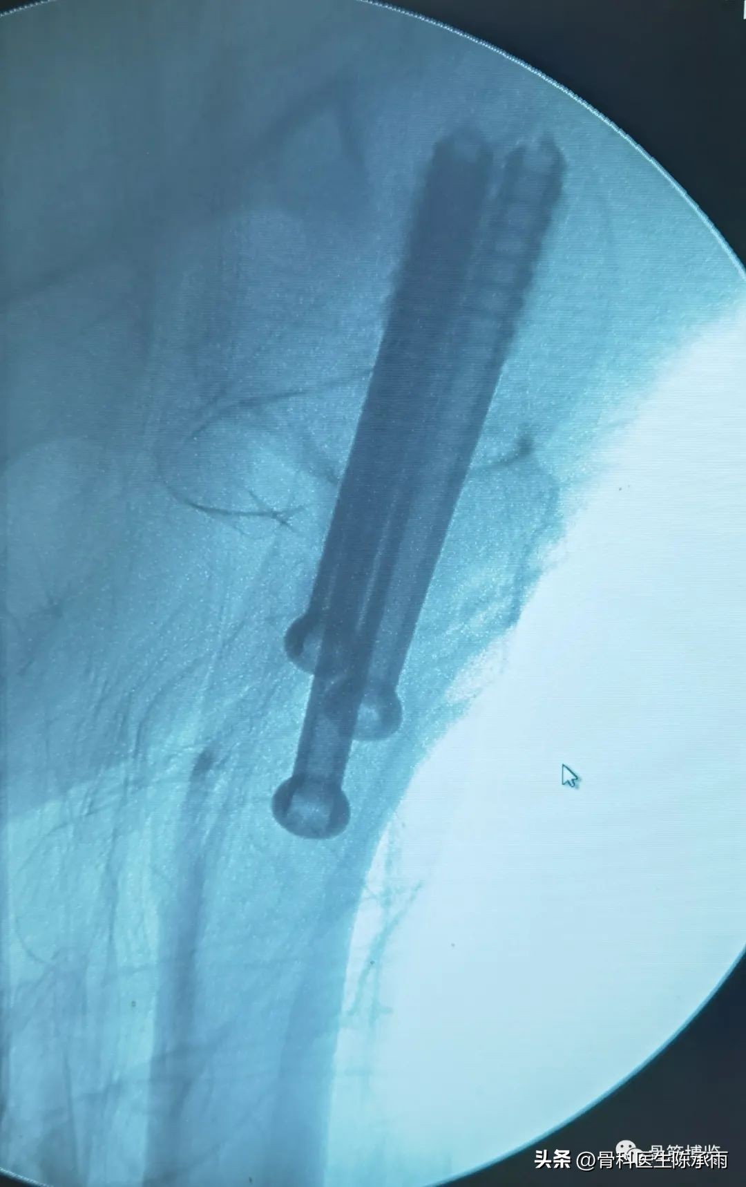 股骨颈闭合复位内固定术后护理,股骨颈骨折闭合复位的技巧