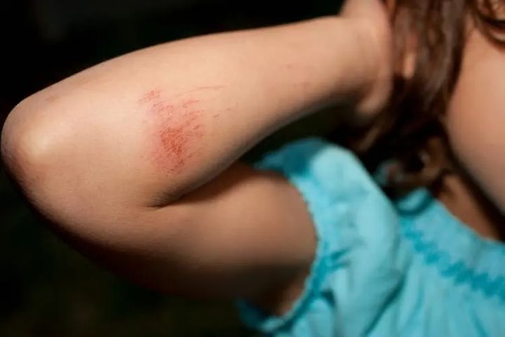 疤痕膏哪个牌子最好最有效,疤痕膏和疤痕贴哪个更好