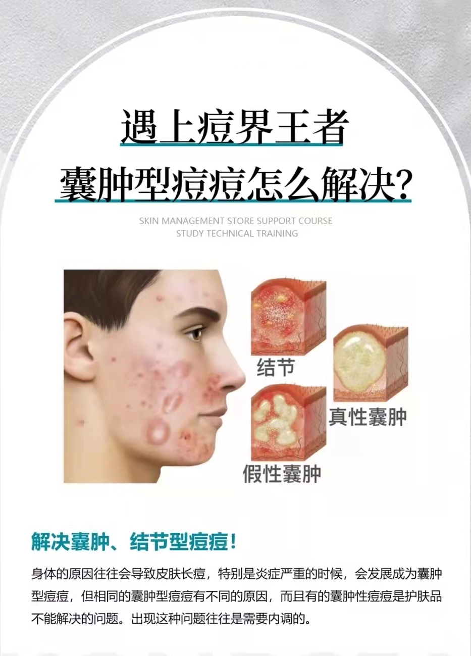 囊肿型痘痘怎么避免,痘痘形成的囊肿怎么去除