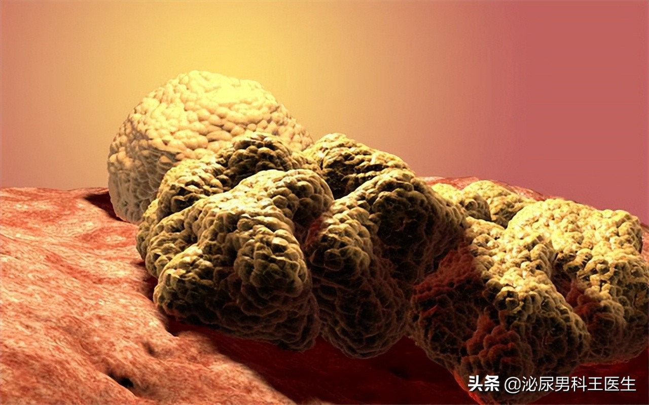 “难以启齿”的肛管癌，你了解它吗？出现3个症状，及时就医检查