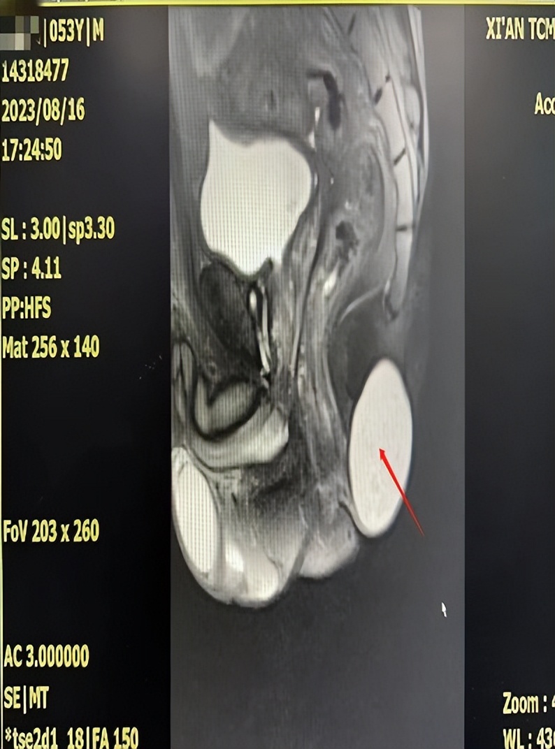 肛肠病医院二病区成功实施骶尾部巨大肿物切除术