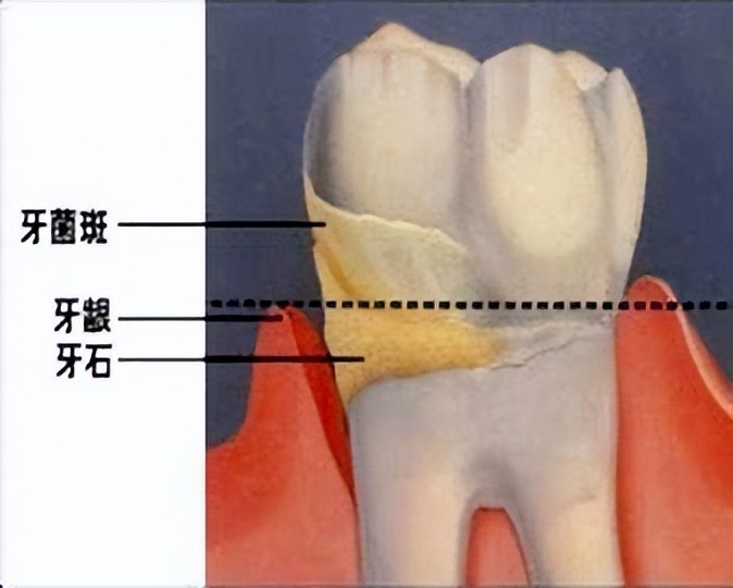 牙缝间牙结石怎样清除干净,牙缝表面的牙结石怎么洗掉