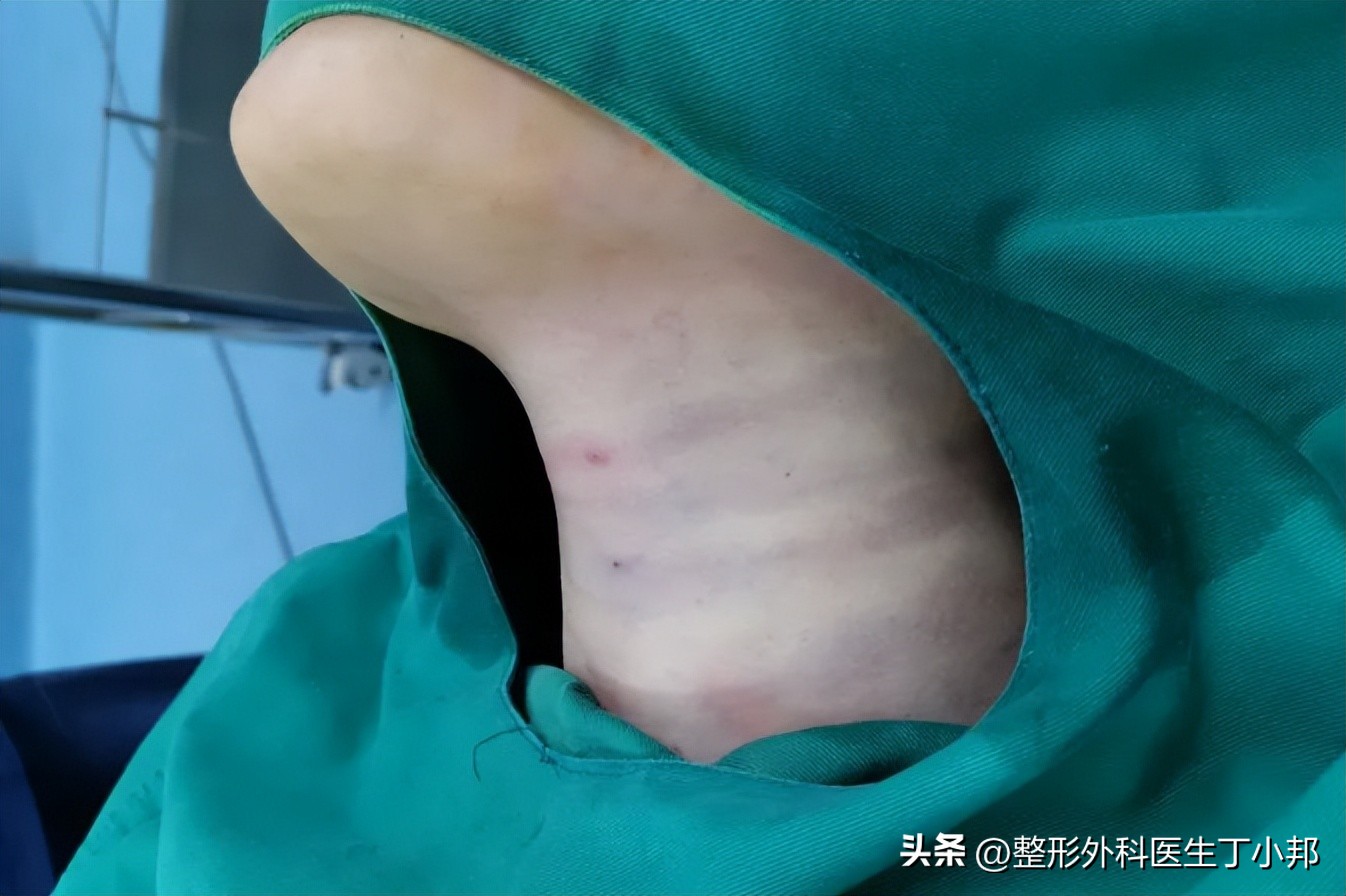 填充颈纹后变白色条怎么消除,颈纹玻尿酸填充