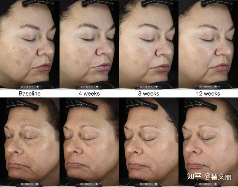 比较温和的美白祛斑精华,小编给大家推荐几款有效祛斑精华