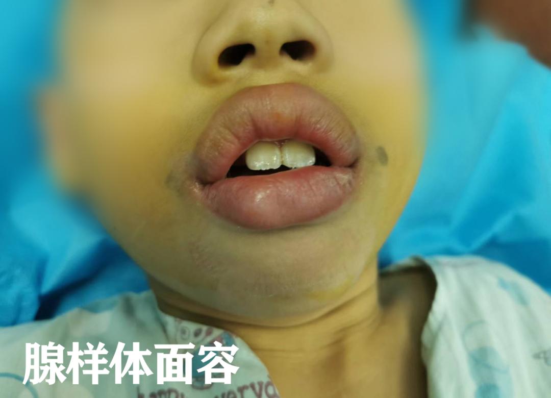 儿童腺样体肥大最佳治疗方案,儿童腺样体肥大家长切莫轻视