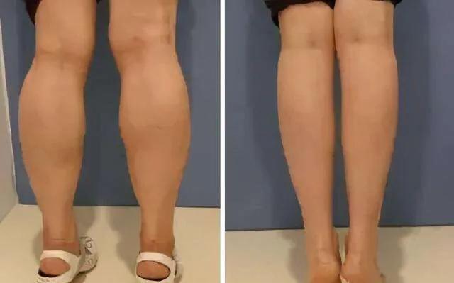 跑步长小腿肌肉吗,跑步长肌肉会不会变重