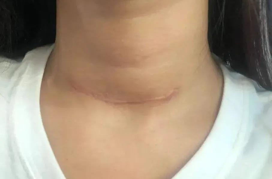 甲切术后疤痕恢复,剪完甲沟炎后如何快速愈合