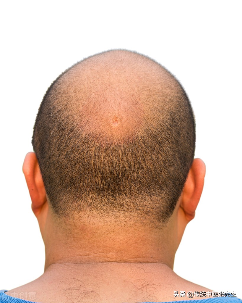 患上斑秃怎么治疗好,治疗斑秃有什么忌口