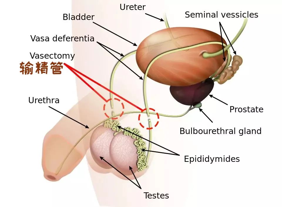 女子生1儿2女被丈夫要求去结扎，网友：应该全面普及男性结扎