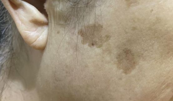 怎样去除皮肤长斑,皮肤长斑怎么去角质