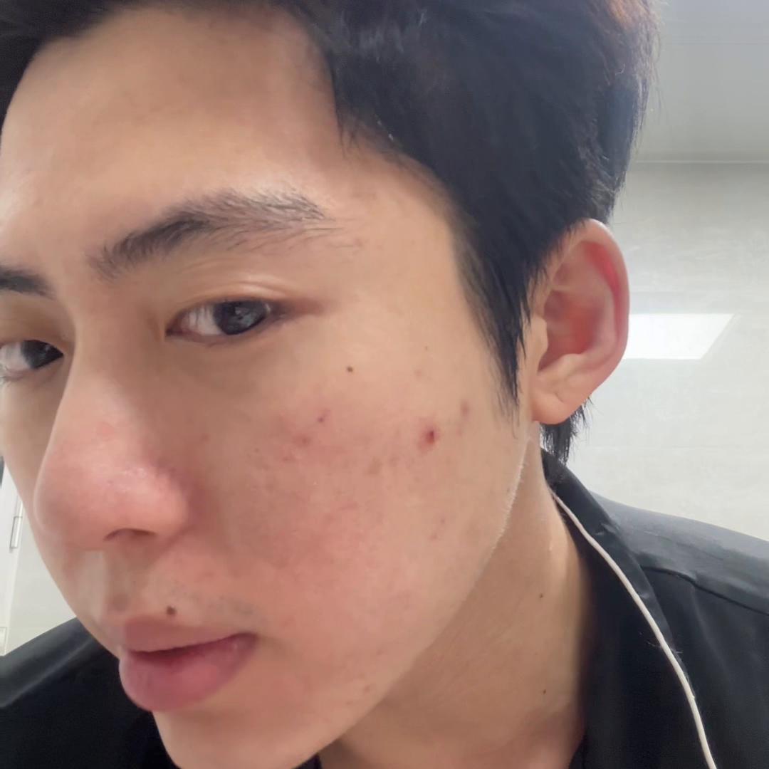 从长痘到祛痘到去印子，7天记录欢迎学习#测评