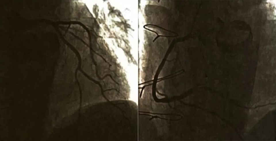 瓣膜置换术后心率快怎么办,瓣膜置换后如何预防心梗