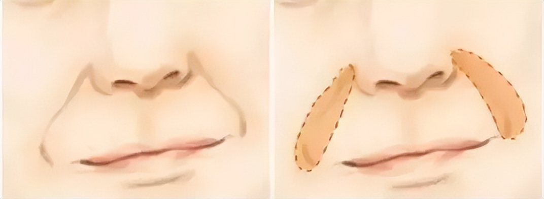 在九院祛法令纹,九院韦敏鼻基底填充与法令纹填充